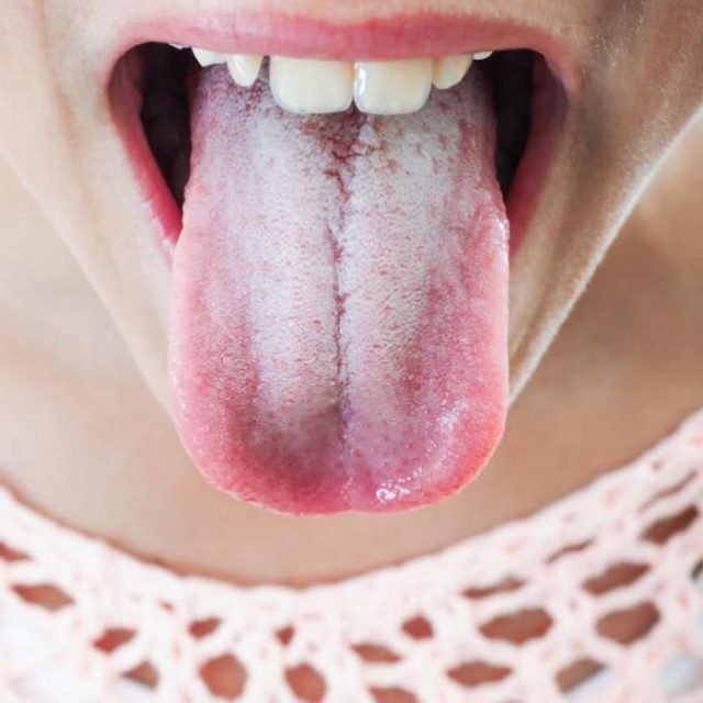 Цвет языка при коронавирусе