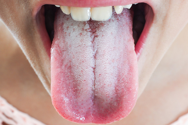 Цвет языка при коронавирусе