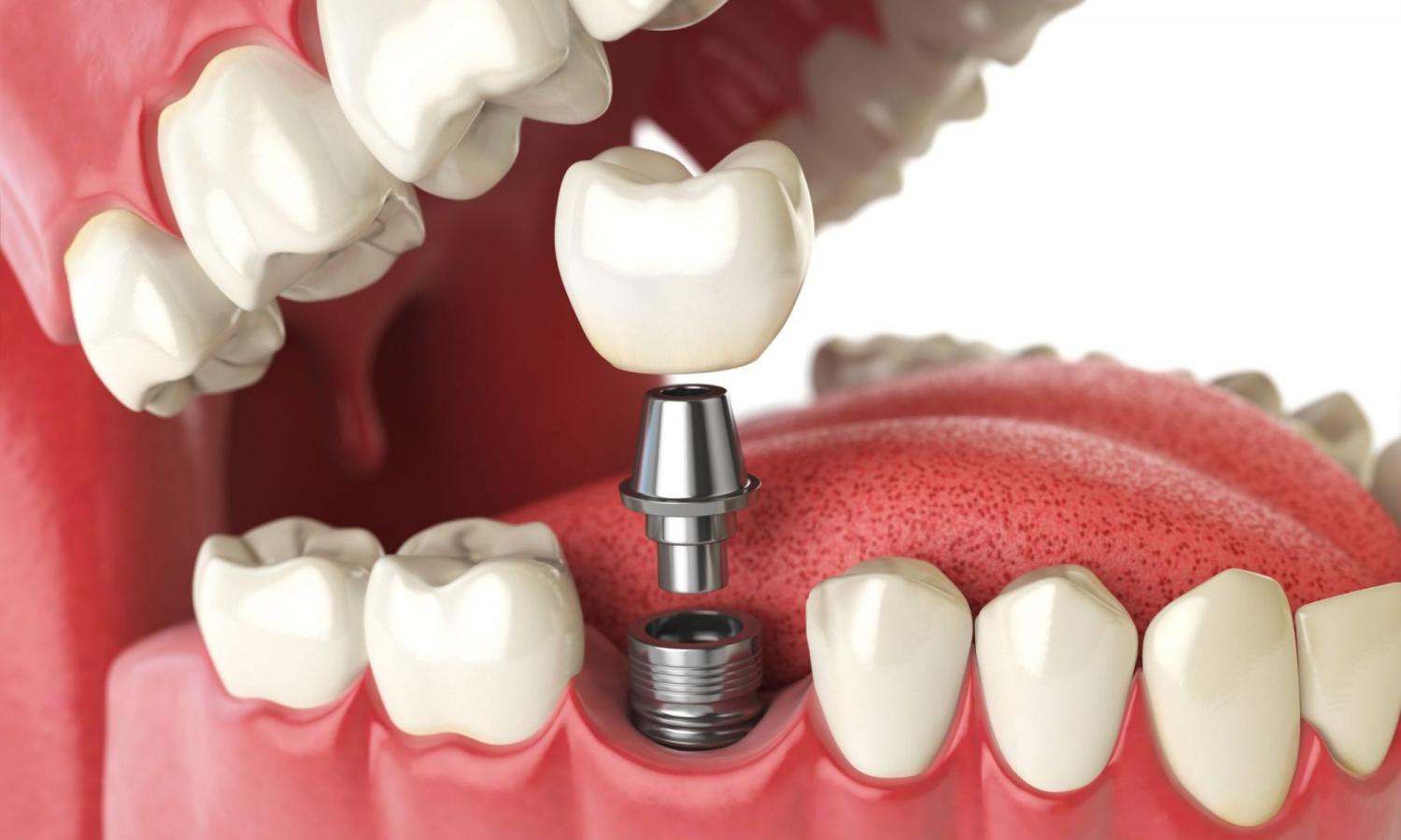 3 основные стадии установки импланта зубов